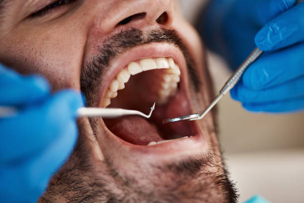 Best Emergency Wisdom Teeth Removal in Westchester, FL